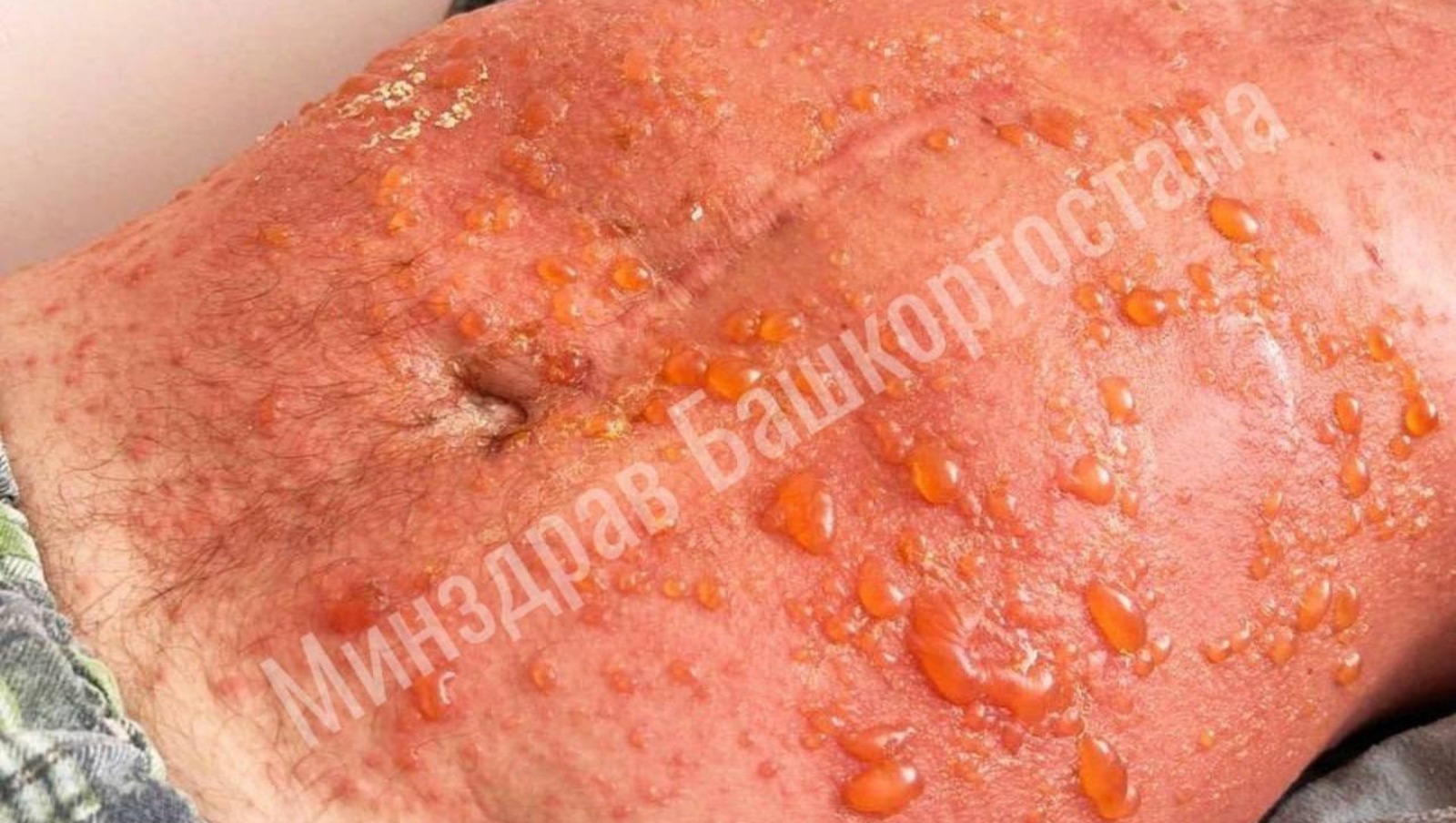 тг-канал Минздрава РБ.