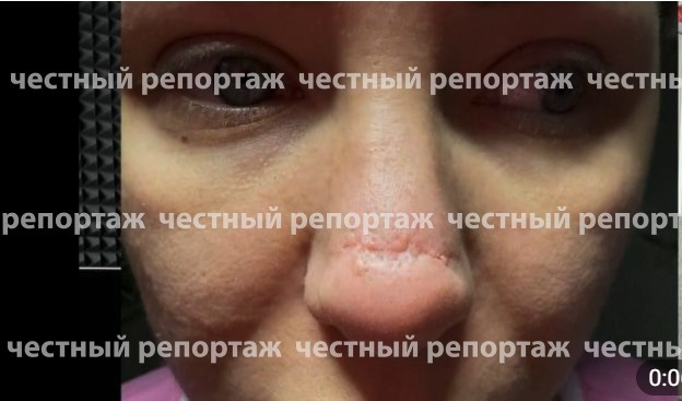 Девушке из Уфы за 900 тысяч рублей изуродовали нос